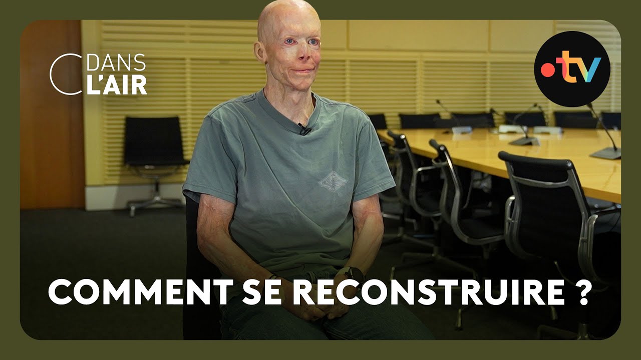 Témoignage d'un grand brûlé